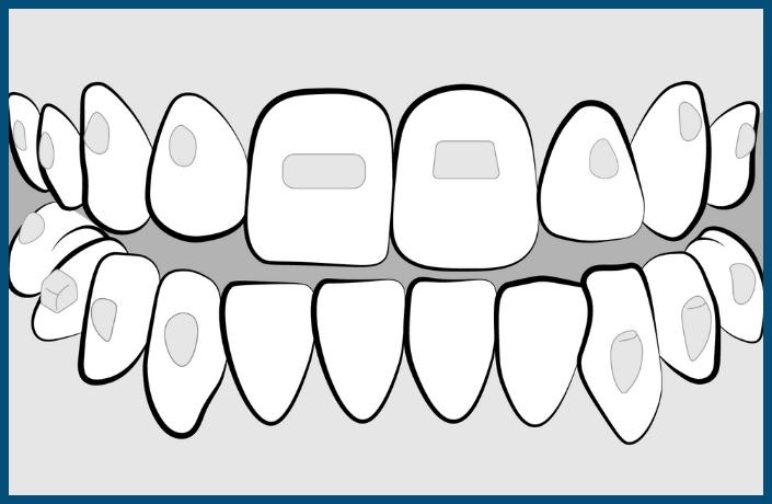 Class 3 Carriere Invisalign Treatment Steps - Cooney & Tyner Orthodontics